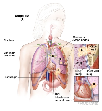 Lung-MAP Trial Eligibility Expanded to Include Patients with All Non-small Cell Lung Cancers