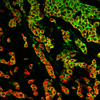 DCTD Scientists Develop a Clinical Monitoring Tool for Epithelial-Mesenchymal Phenotype