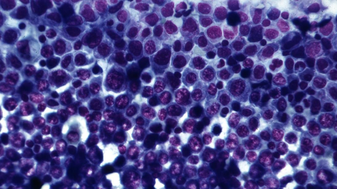 Image of closely crowded blue leukemia cells representing acute myeloid leukemia.