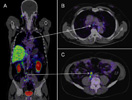 PSMA PET-CT Accurately Detects Prostate Cancer Spread, Trial Shows; Cancer Currents Blog Featuring Lalitha Shankar, MD, PhD