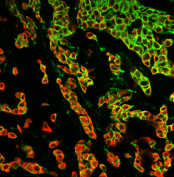 DCTD Scientists Develop a Clinical Monitoring Tool for Epithelial-Mesenchymal Phenotype