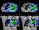 Is Proton Therapy Safer than Traditional Radiation; Cancer Currents Blog Featuring Jeffrey Buchsbaum, MD, PhD<