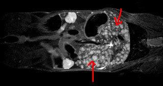 MRI image of the bladder cancer model BL0293-F563 that reliably metastasizes to the liver before or after removal of the primary subcutaneous tumor in NSG host mice; arrows indicate liver metastases