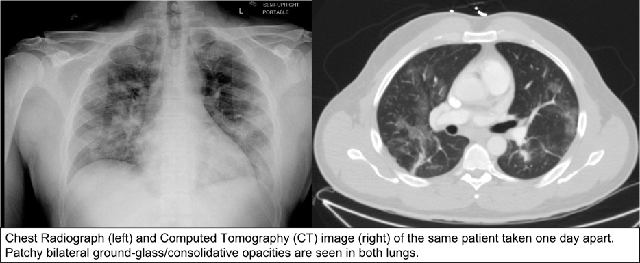 Chest Radiograph (left) and Computed Tomography (CT) image (right) of the same patient taken one day apart. Patchy bilateral ground-glass/consolidative opacities are seen in both lungs.