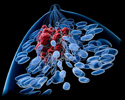 Trial Tests Abemaciclib as New Option for Early-stage Breast Cancer; Cancer Currents Blog Featuring Dr. Larissa Korde