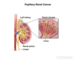 Targeted Therapy Cabozantinib Slows Progression of Rare Kidney Cancer