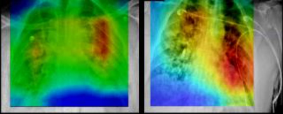 The images show an automated identification of regions of prognostic importance on baseline chest radiographs (left). The regions of highest prognostic importance (as determined by the AI algorithm) are observed primarily in lower lung regions (right), consistent with clinical findings on the corresponding chest x-rays.