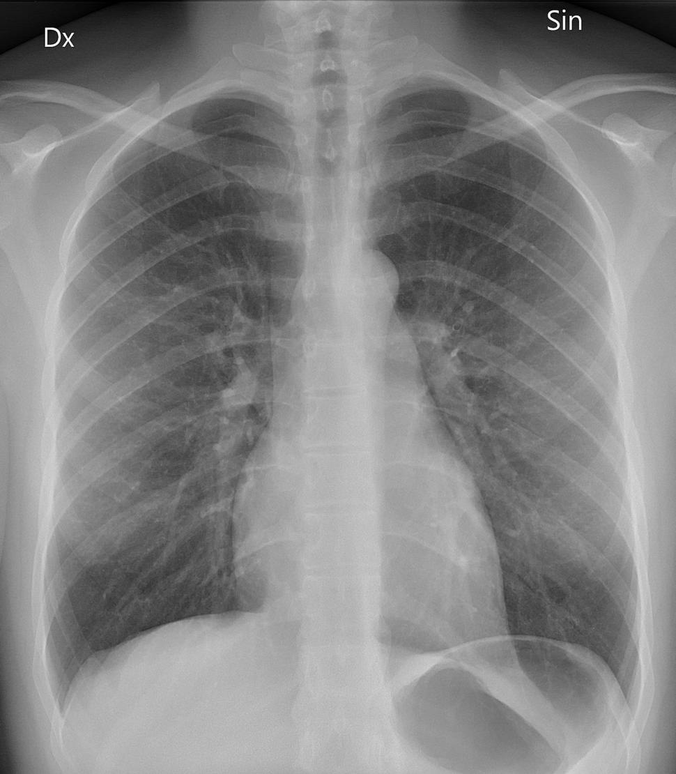 An posteroanterior x-ray image of a person’s chest. The background of the image is black and the x-ray image itself is white. The left side is labeled “Dx” and the right side is labeled “Sin”. 