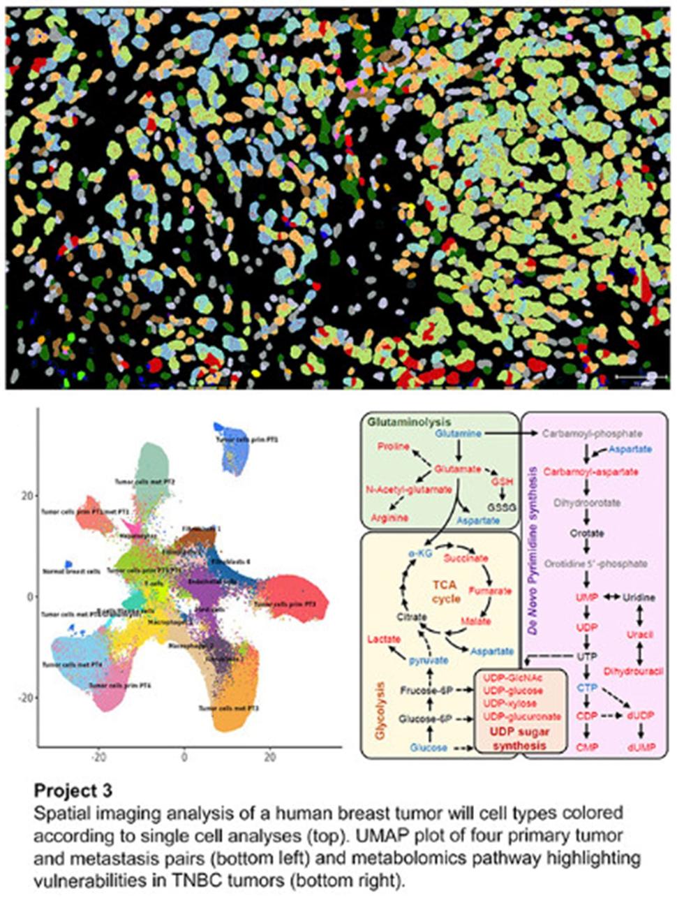 The top image shows spatial imaging of a human breast tumor while the bottom section features a UMAP plot comparing four pairs of primary tumors and their metastasis pairs, alongside a diagram of a metabolomics pathway.