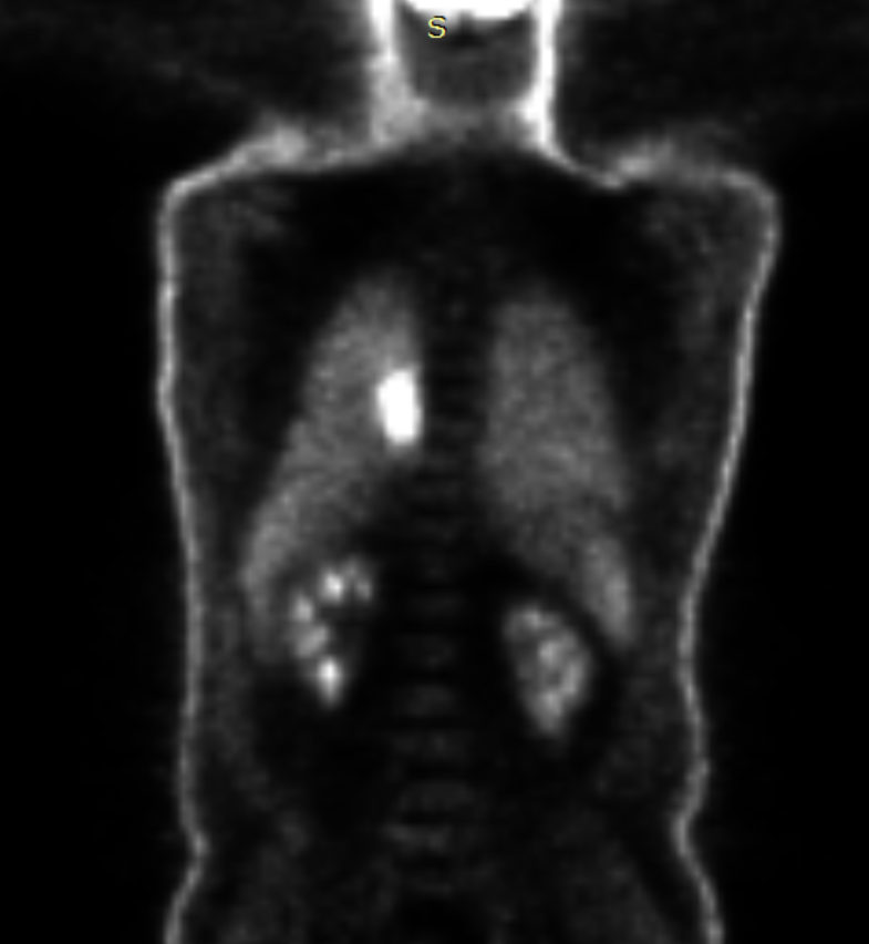 A FDG PET scan of a person’s upper body. The silhouette of thread, neck and torso have a faint white outline. Both lungs are a dark grey, with a spot in the upper portion of the left lung a bright write. The rest of the image is black.