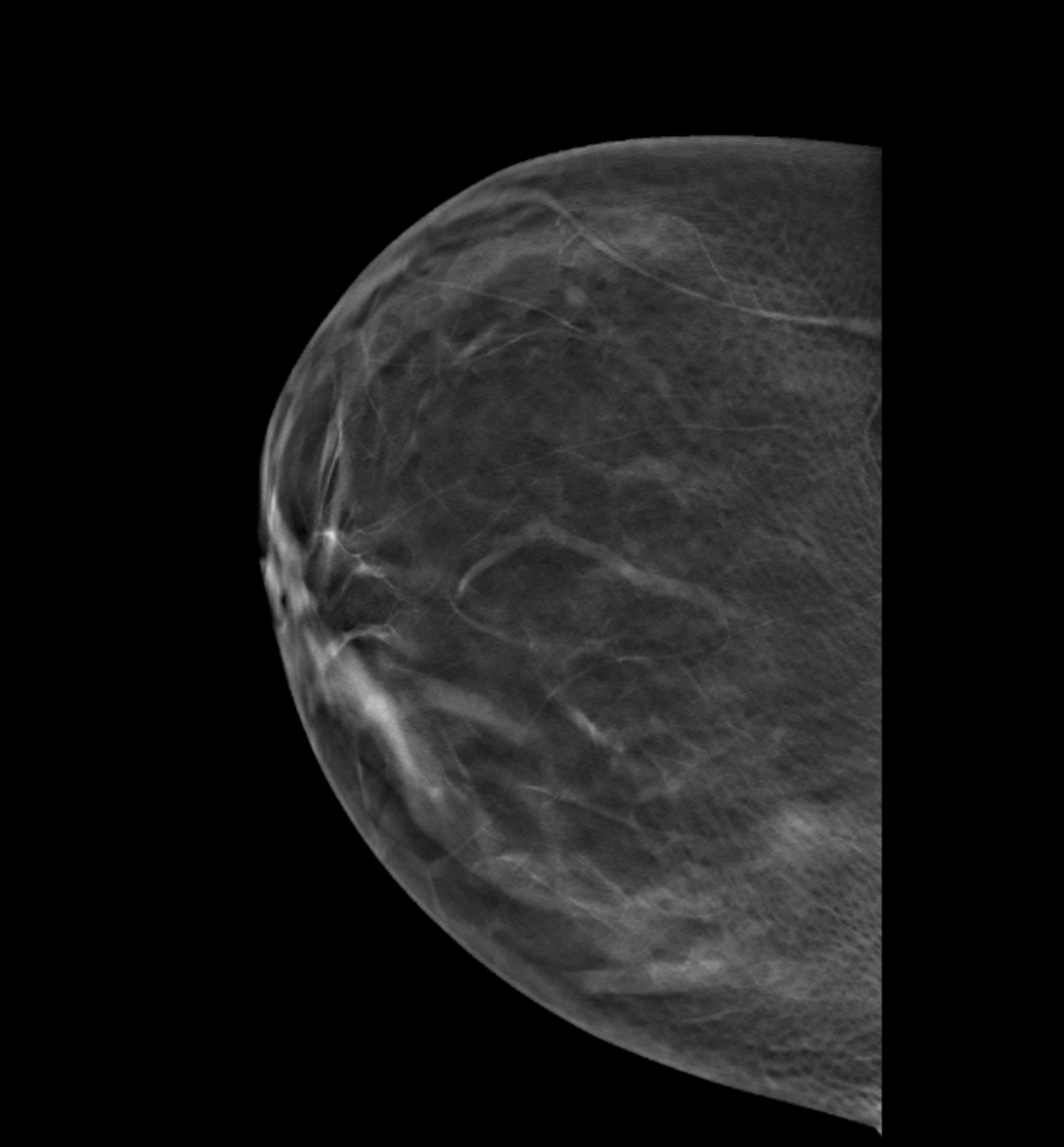 Breast Mammogram