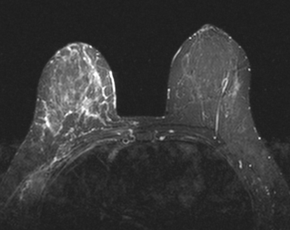 A breast MRI. The majority of the body that is visible is dark grey. The left breast has noticeably more white shapes and lines contained within it as compared to the right breast, which is similarly colored to the rest of the body.