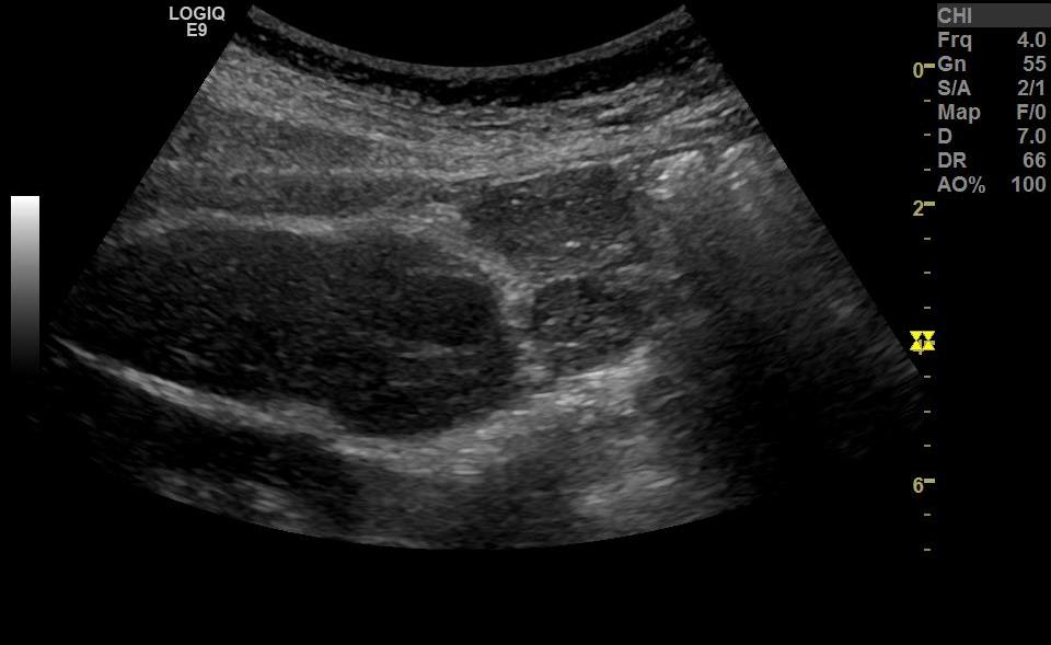 B-mode Liver Ultrasound