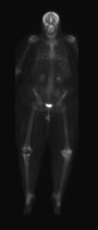 A fully body SPECT scan of an adult. The skeleton is mostly grey on a black background. The skull is slightly brighter and the pelvis has a small, bright white area.