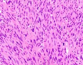 Leiomyosarcoma cells stained with hematoxylin and eosin.