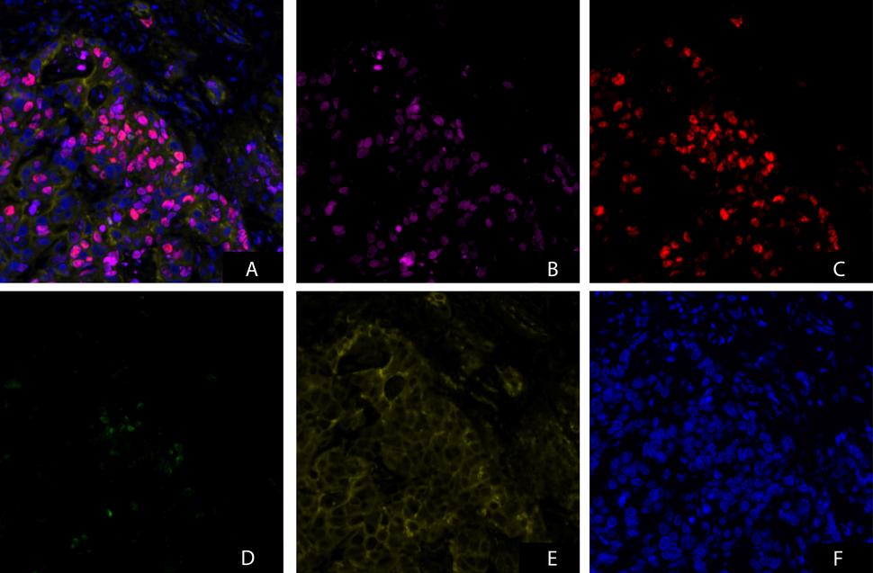 An example of γH2AX, pNBS1, pKAP1 IFA with β-CATN Segmentation IFA assay image of a patient tumor biopsy from an ETCTN clinical study analyzed by NCLN PD Assay Laboratory at MD Anderson. Images from all channels merged and individual channel are shown. (A) Merged image from all channels (B) γH2AX channel (C) pNBS1 channel (D) pKAP1 channel (E) β-Catenin channel (F) DAPI channel.