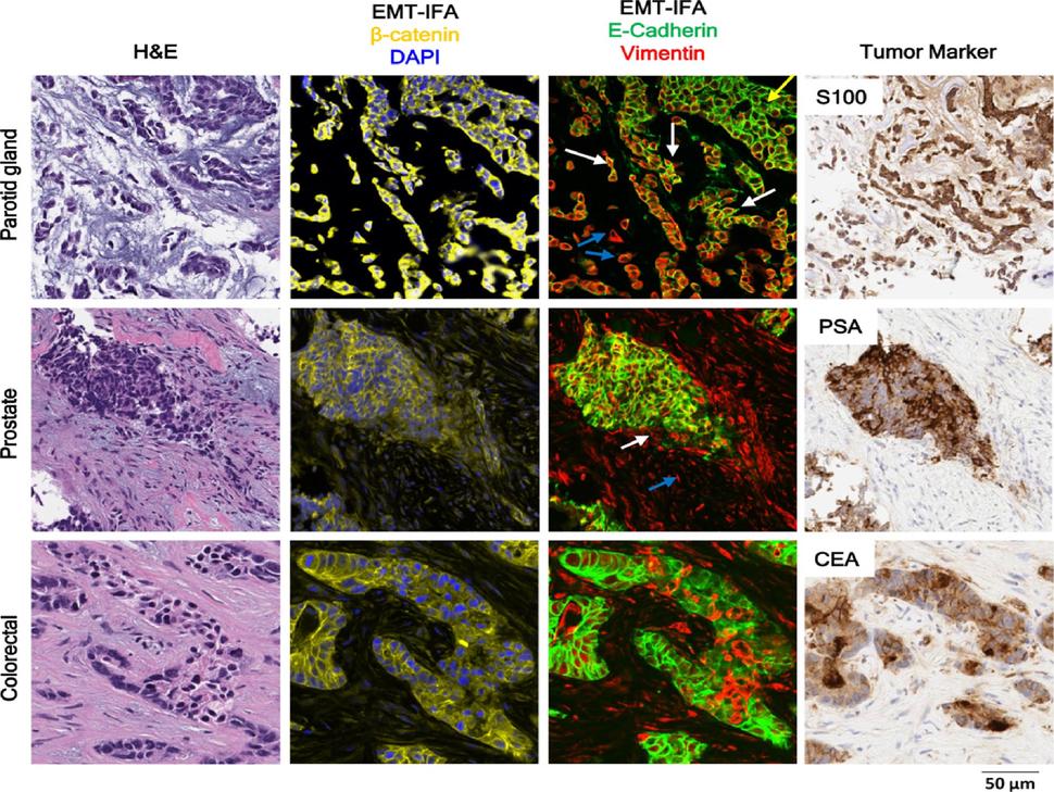 IFA tumor tissue staining panel highlighting EMT markers