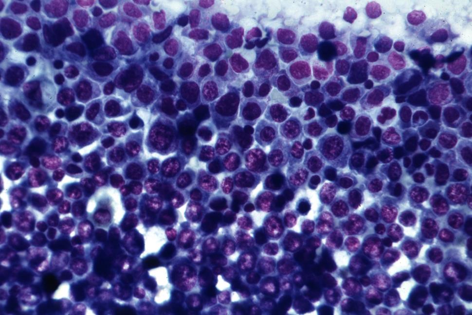 Image of closely crowded blue leukemia cells representing acute myeloid leukemia.