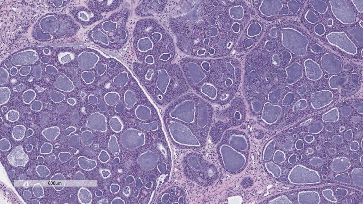 An example of haematoxylin and eosin stain of adenoid cystic carcinoma tissue at 4X resolution