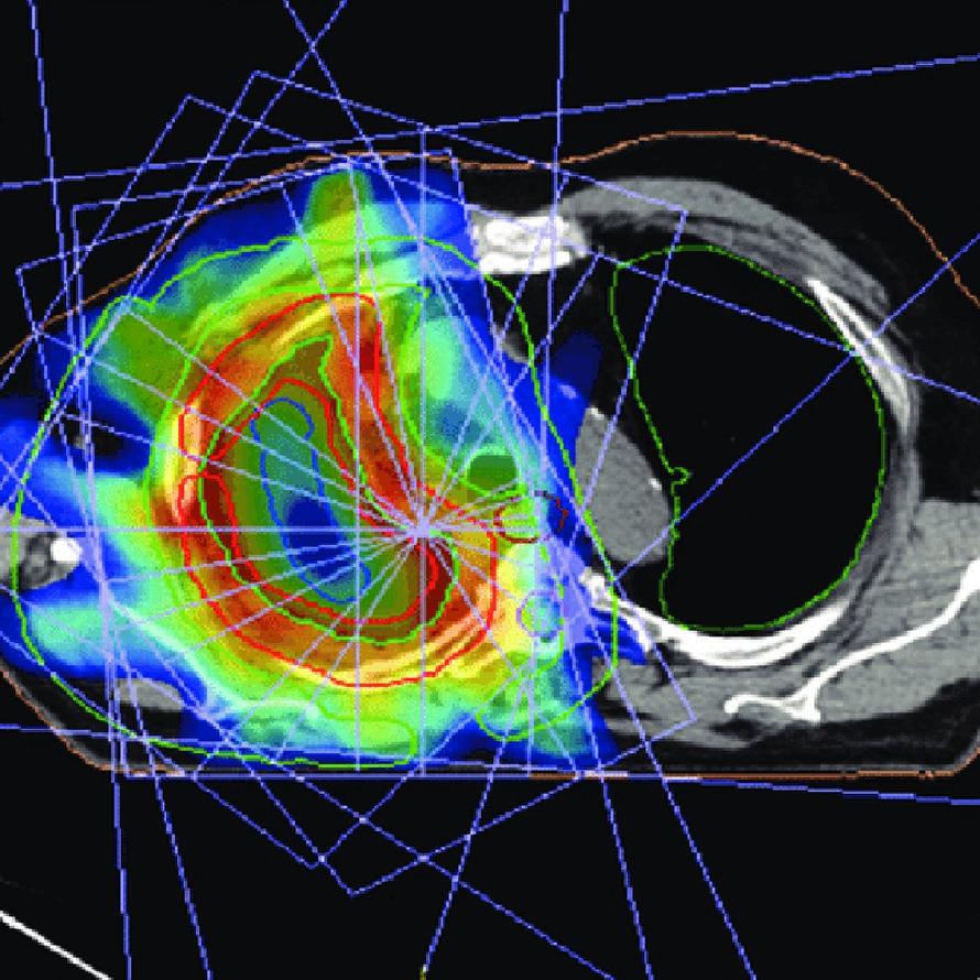 CT scan of a chest with colorful overlays indicating radiation treatment zones. Blue lines form a geometric pattern around the targeted area.