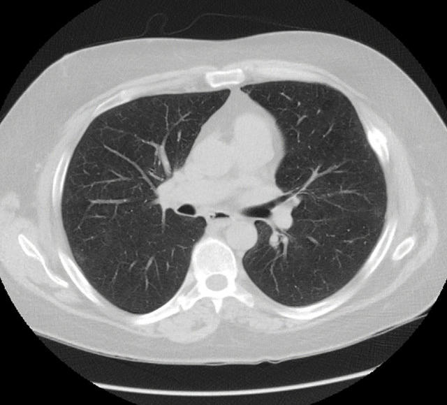 Lung CT Scan