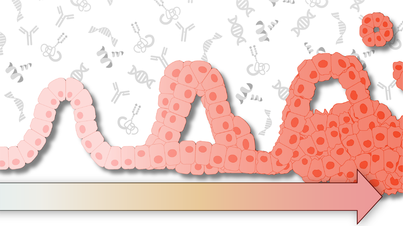 graphic depicting progression from normal tissue to IPMN to PDAC